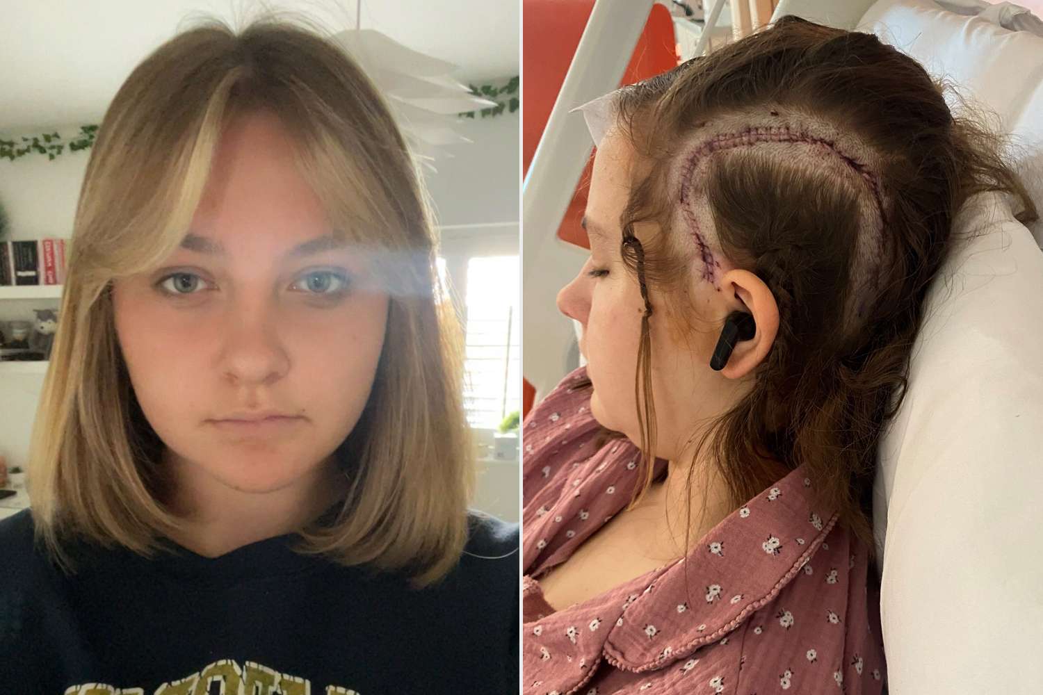 Teen girl becomes youngest known patient to have awake brain surgery for rare blood vessel condition: 'I've got my life back'