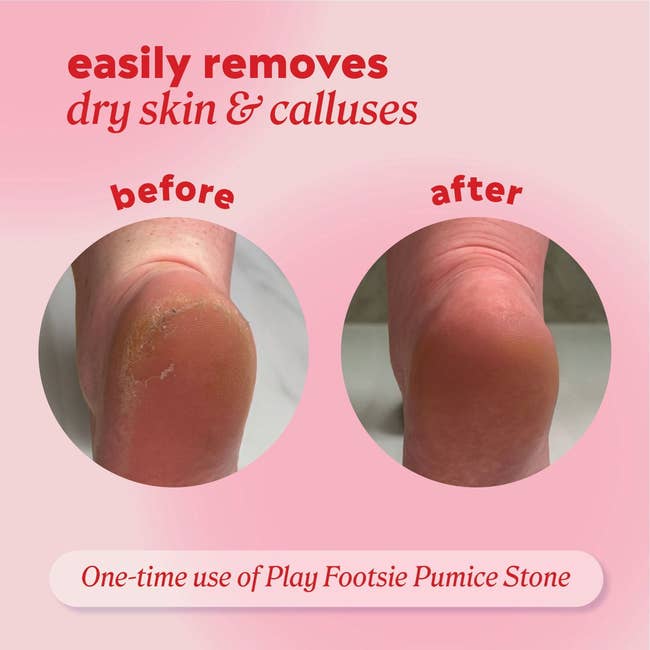 Before and after comparison of foot callus removal using a pumice stone, showing smoother skin post-treatment