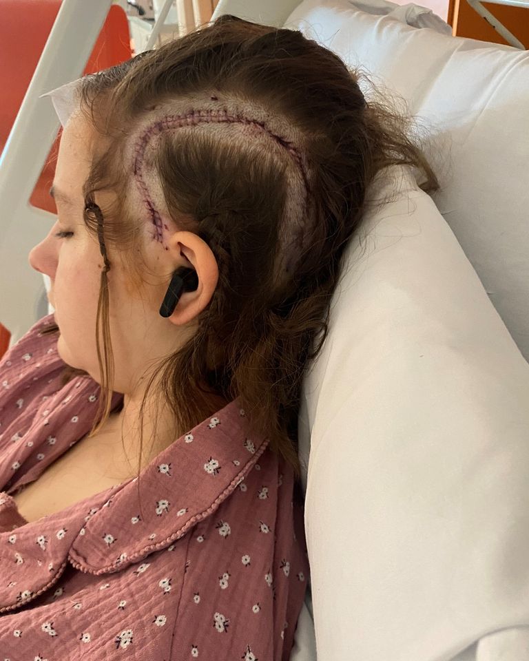 Tilly Phillips, now 16, was 15 when she underwent the conscious craniotomy procedure at Alder Hey Children's Hospital in Liverpool.