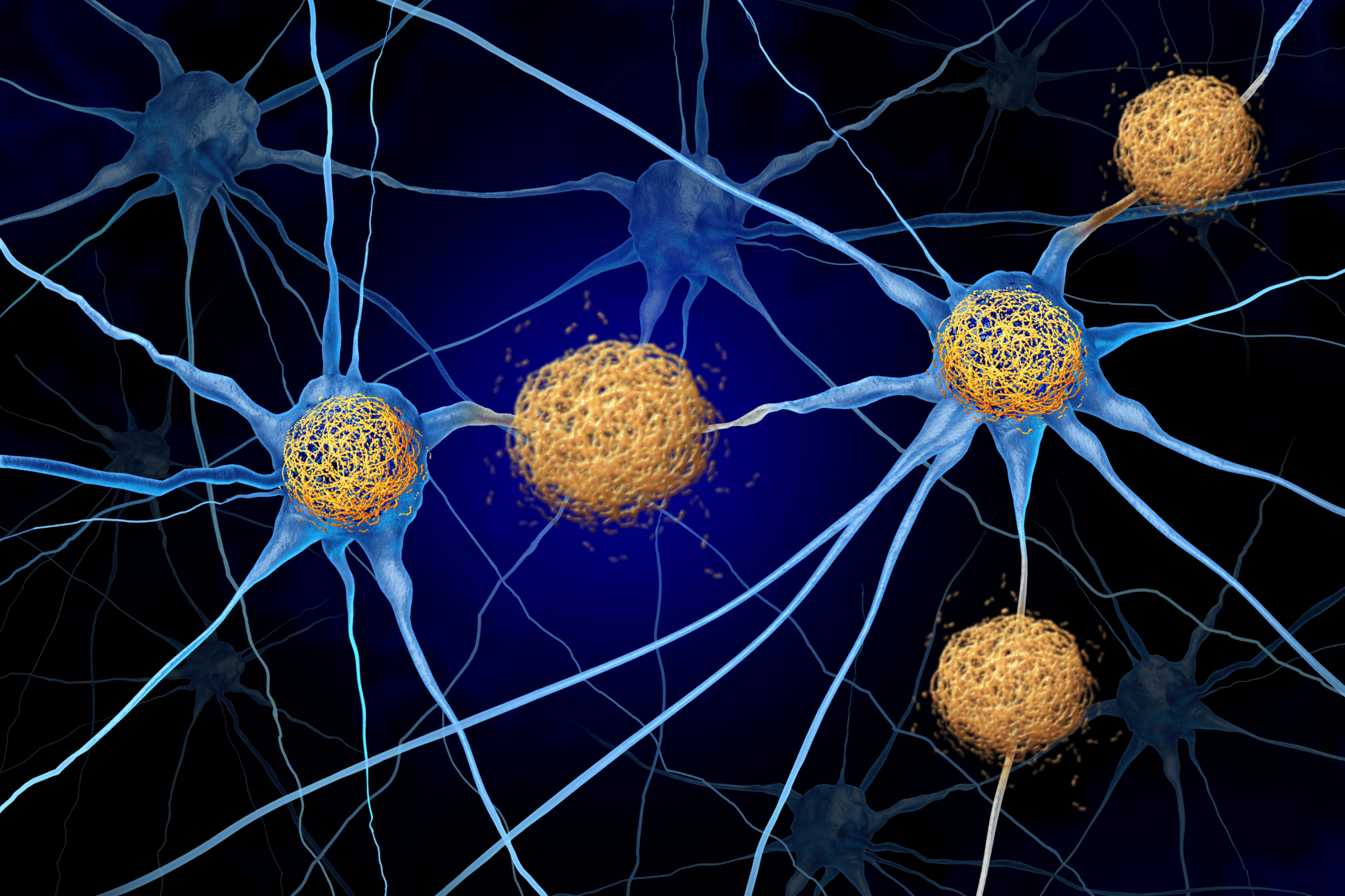 Something hidden may be helping Alzheimer's spread, scientists say