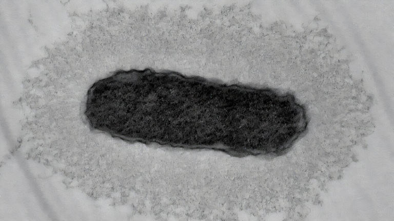 From urinary tract infection to brain abscess: How bacterial ...