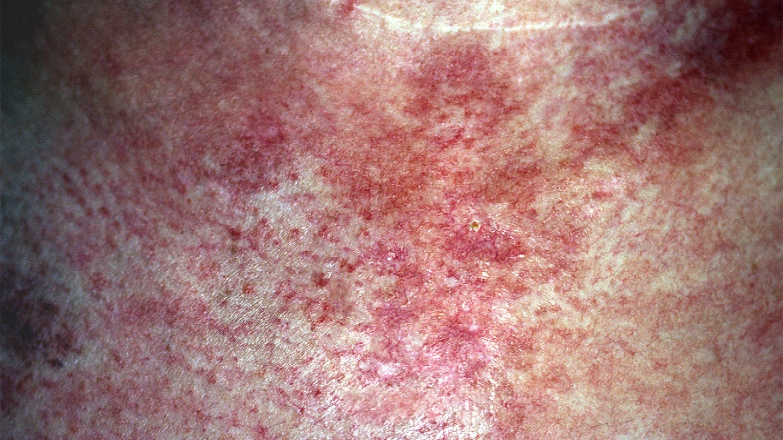Uncommon autonomic tachycardia syndrome linked to classic dermatomyositis
