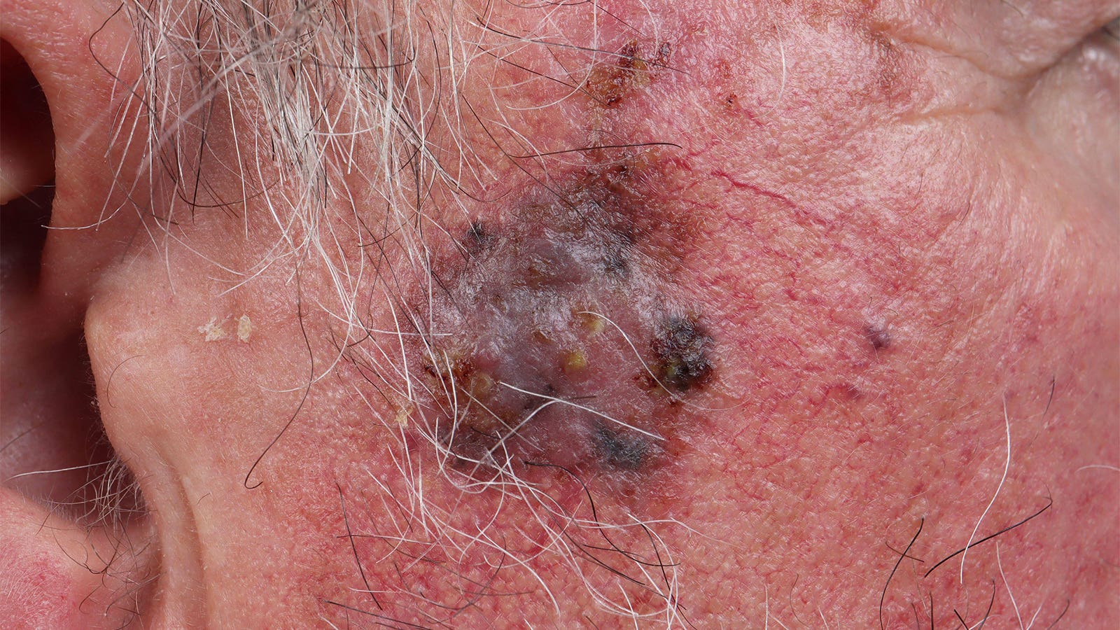Twice-rejected melanoma drug gets love from FDA panel