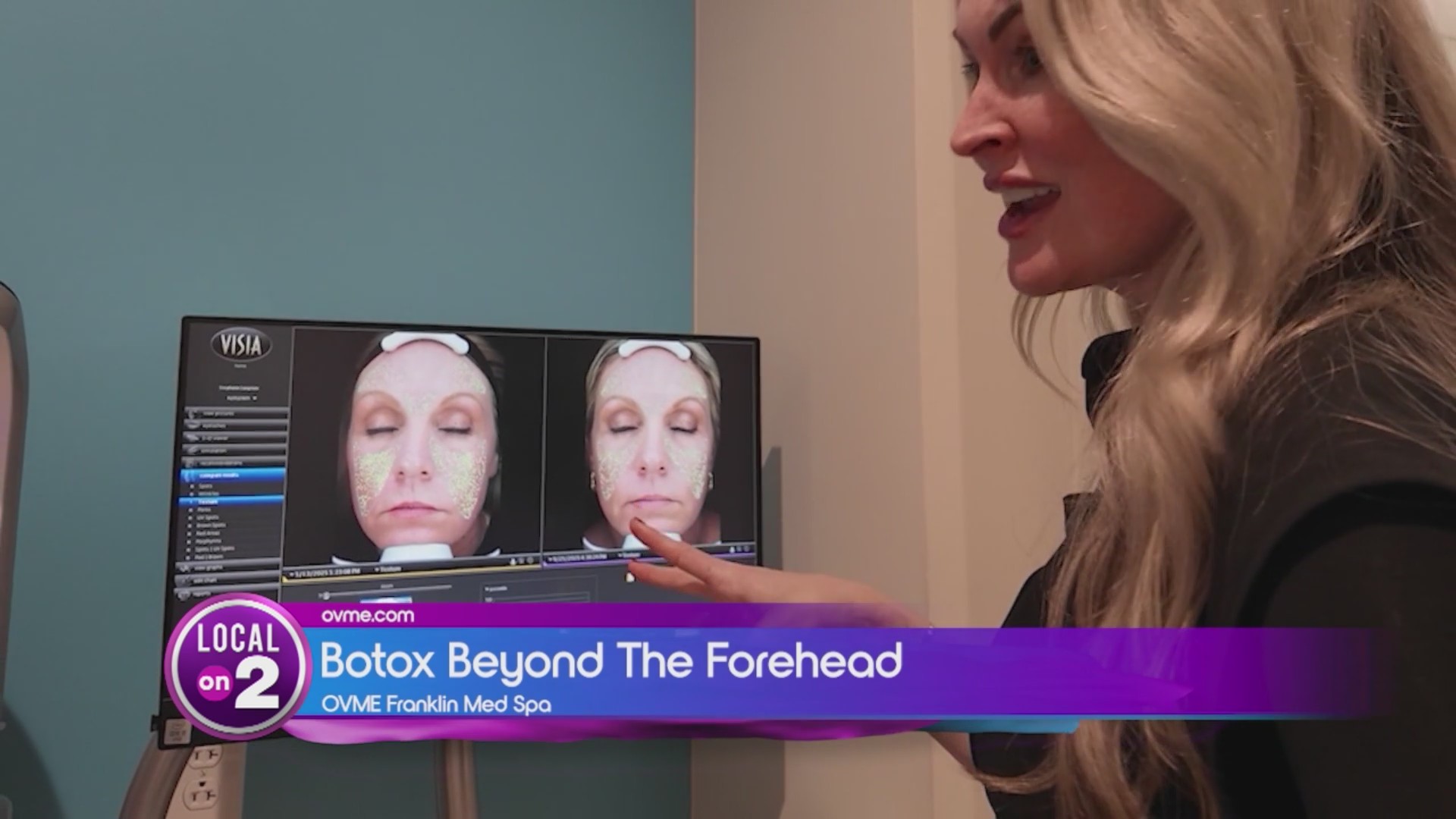 OVME: Botox