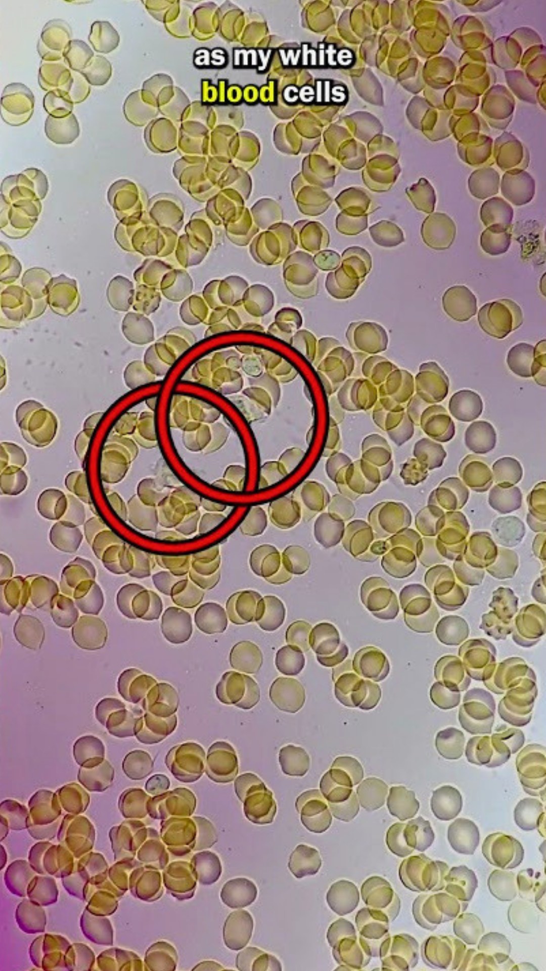 White Blood Cell’s Final Battle Under Microscope