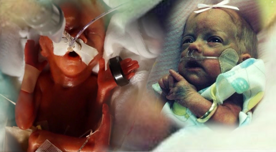 Two tiny survivors share similar birth story