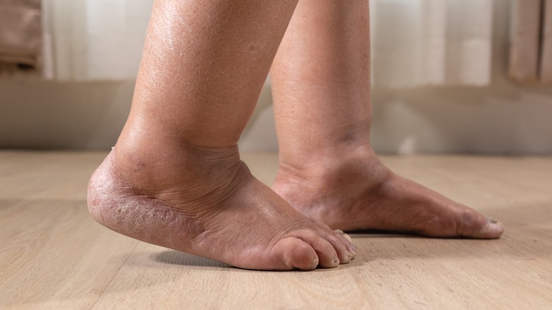 4 signs your swollen feet might require a trip to the doctor