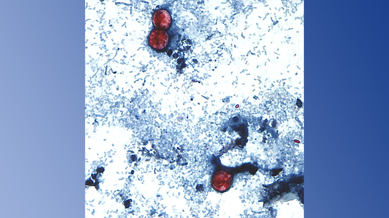 Cyclosporiasis outbreak: 2 deaths linked to illness