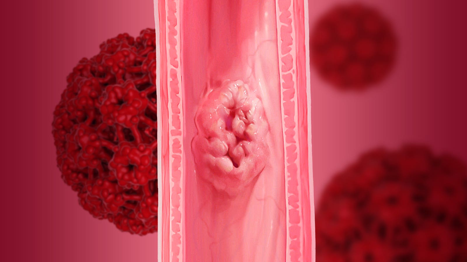 HPV infection and esophageal cancer