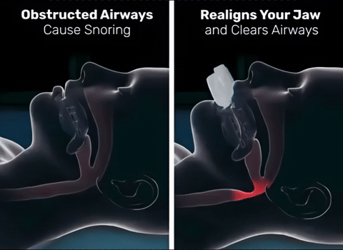 Can't sleep? This anti-snoring mouthpiece takes 2 minutes to mold