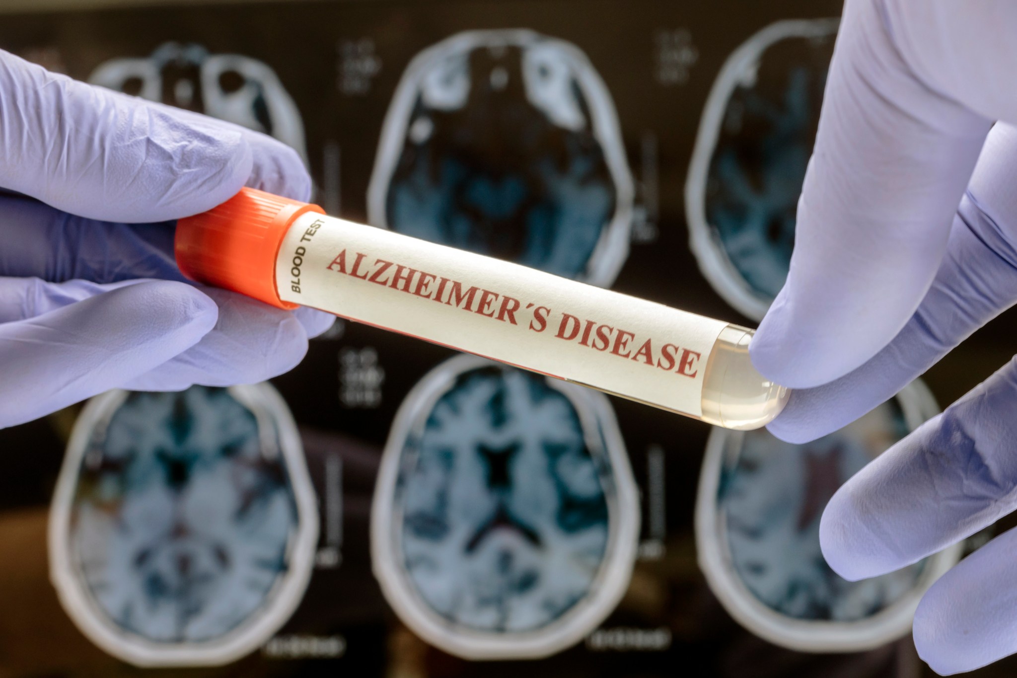 Overlooked body function may predict faster Alzheimer's