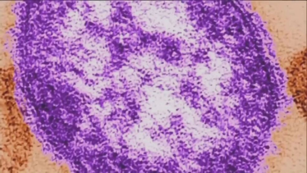 Public health confirms 2 measles cases in Kern County since '04, linked ...