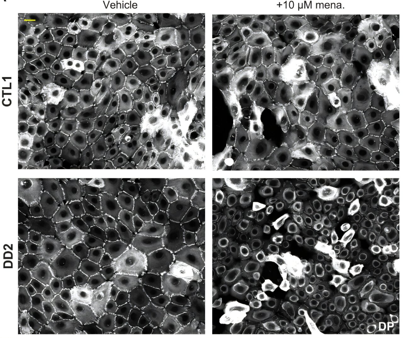 Darier disease cells lose antioxidant defenses under stress, study finds
