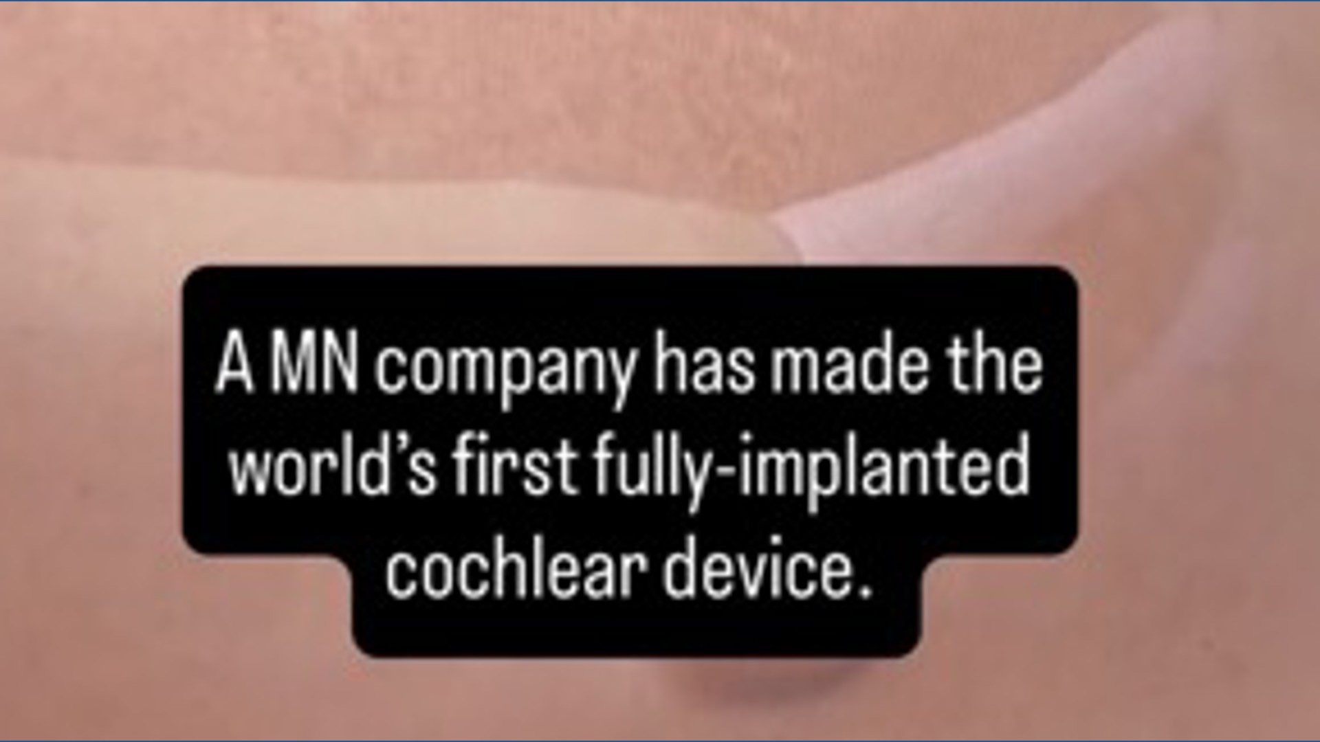 MN makes first fully-implanted cochlear device
