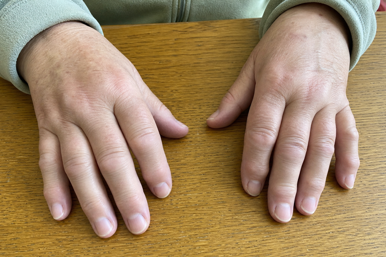 8 warning signs of rheumatoid arthritis most people mistake for normal ...