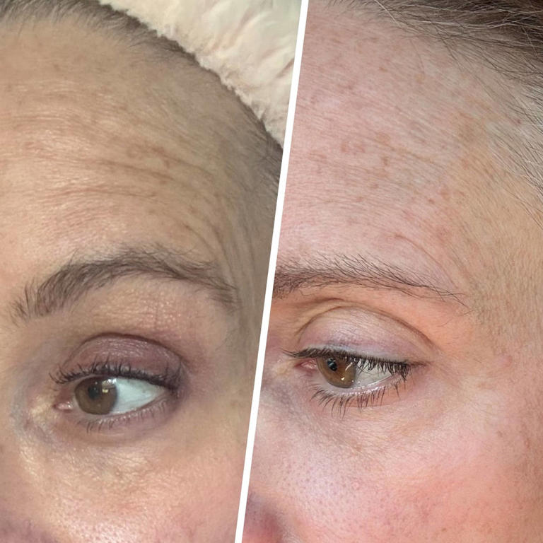 Ranked: The best wrinkle patches to combat fine lines