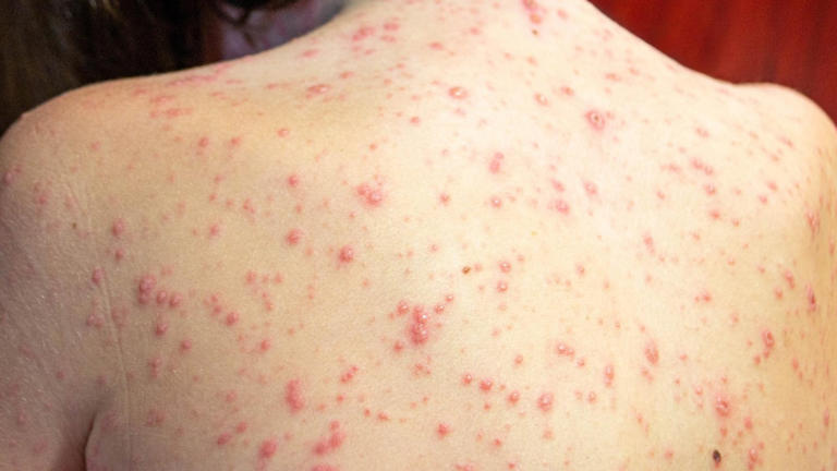 US measles cases just hit a 35-year high, putting the country’s ...