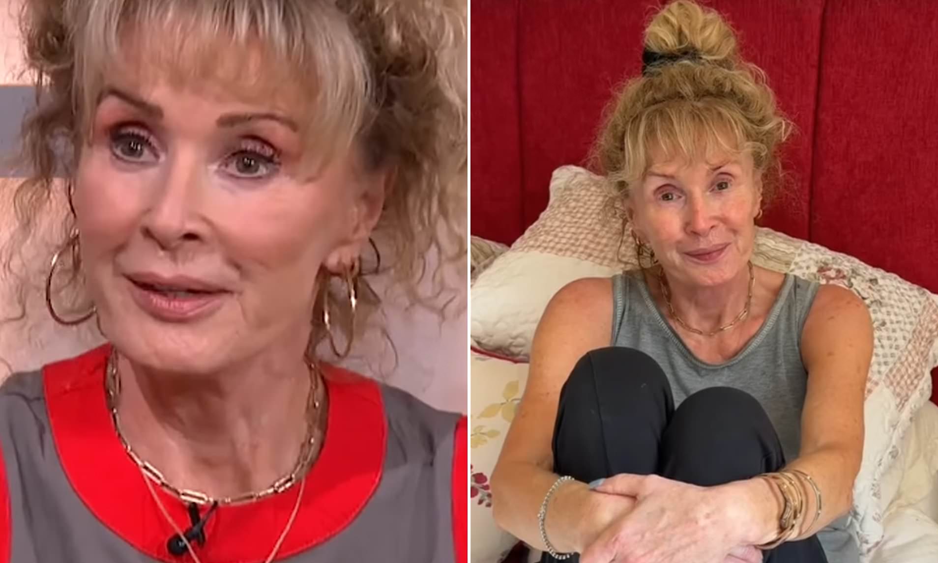 Beverley Callard, 69, says she's 'quite badly burnt' from radiotherapy to treat breast cancer