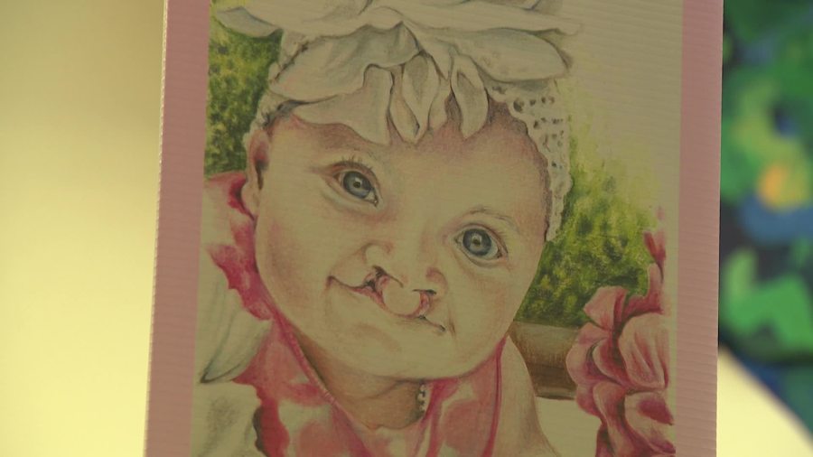 Spring Lake girl with cleft palate featured in traveling art exhibit