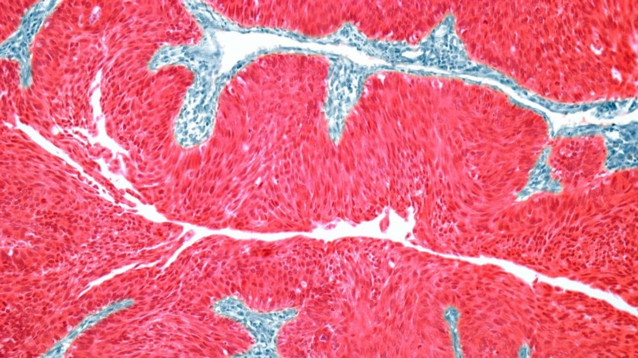 SLS, IBRX stocks in focus: Analyst says Moderna-Merck cancer vaccine ...