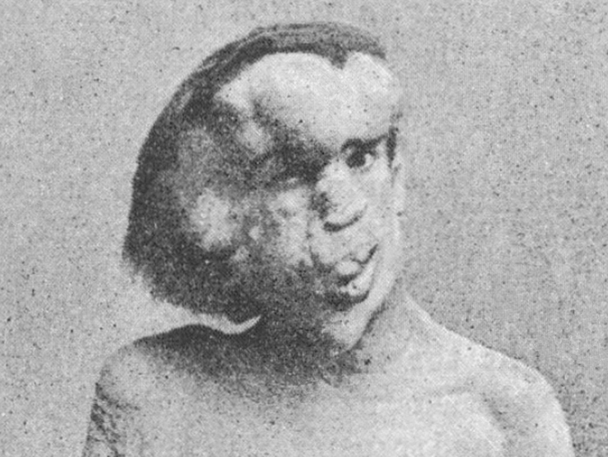The sad truth about Joseph Merrick, the Elephant Man