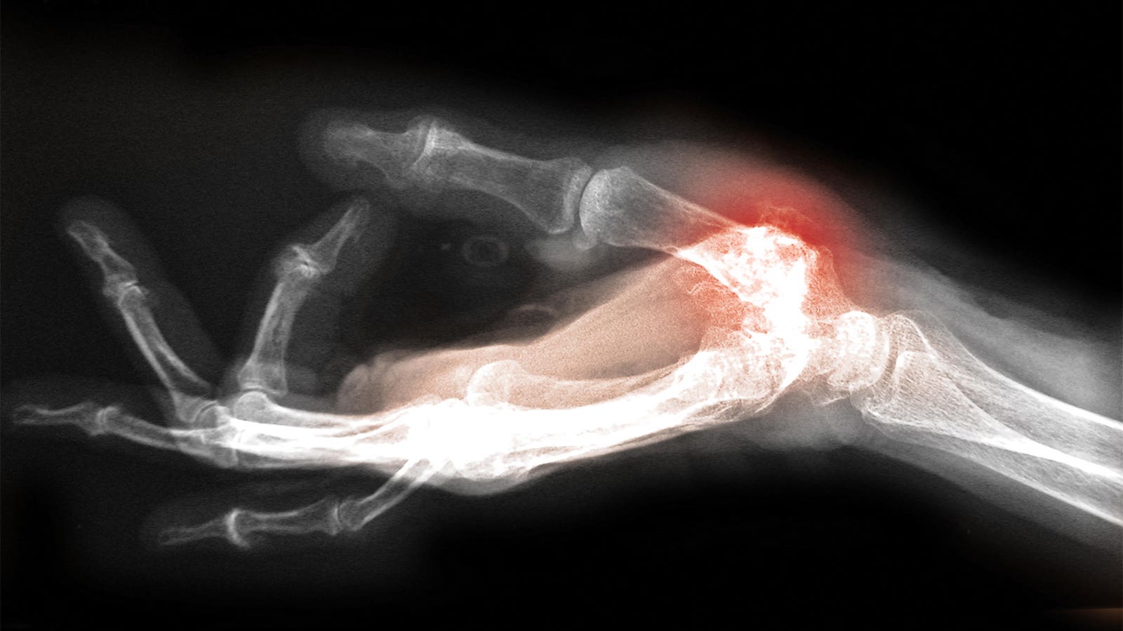 Synovitis confirmed as prognostic in hand osteoarthritis, regardless of subtype