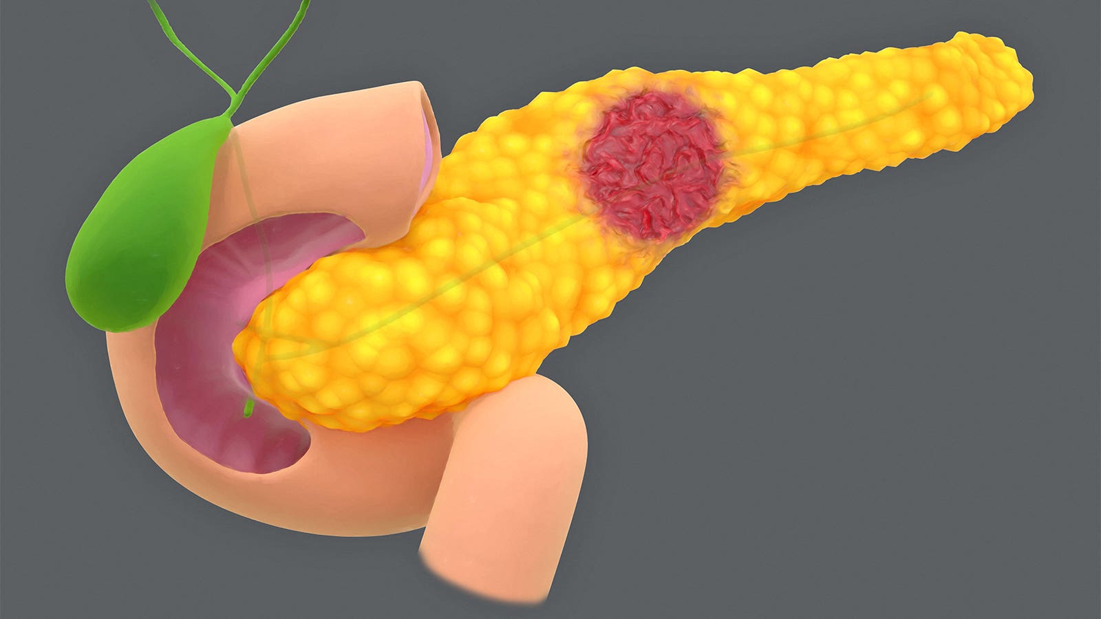 Risk of pancreatic cysts becoming cancer grows as worrisome traits increase