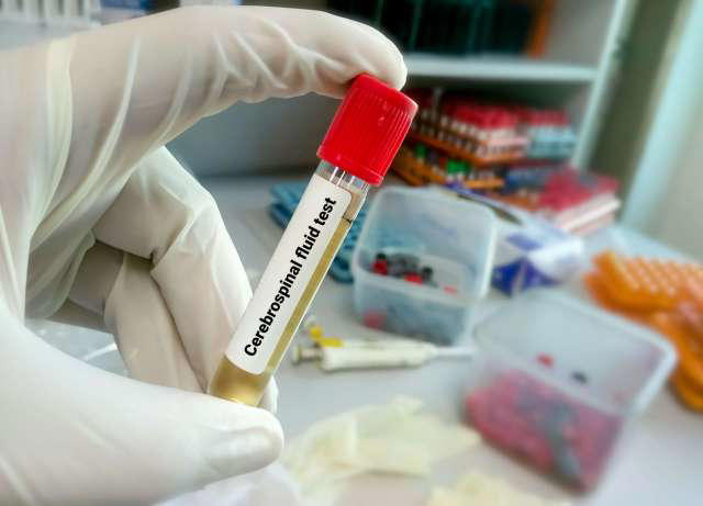 Un estudio en Italia detecta mayor presencia de microplásticos en líquido cefalorraquídeo de personas con ELA