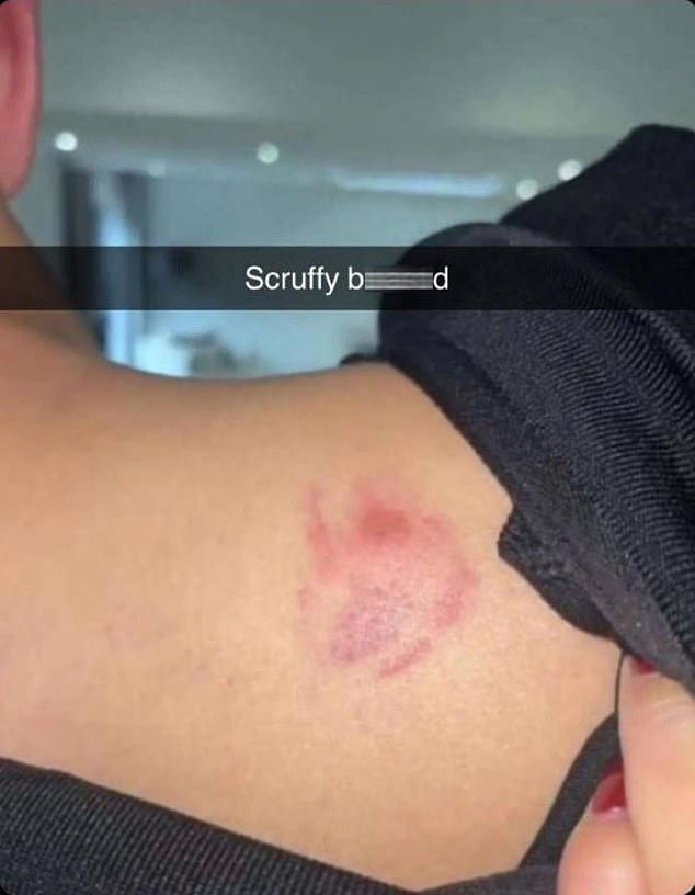 Beck showed off his wound in the aftermath of that incident - but that was only the start