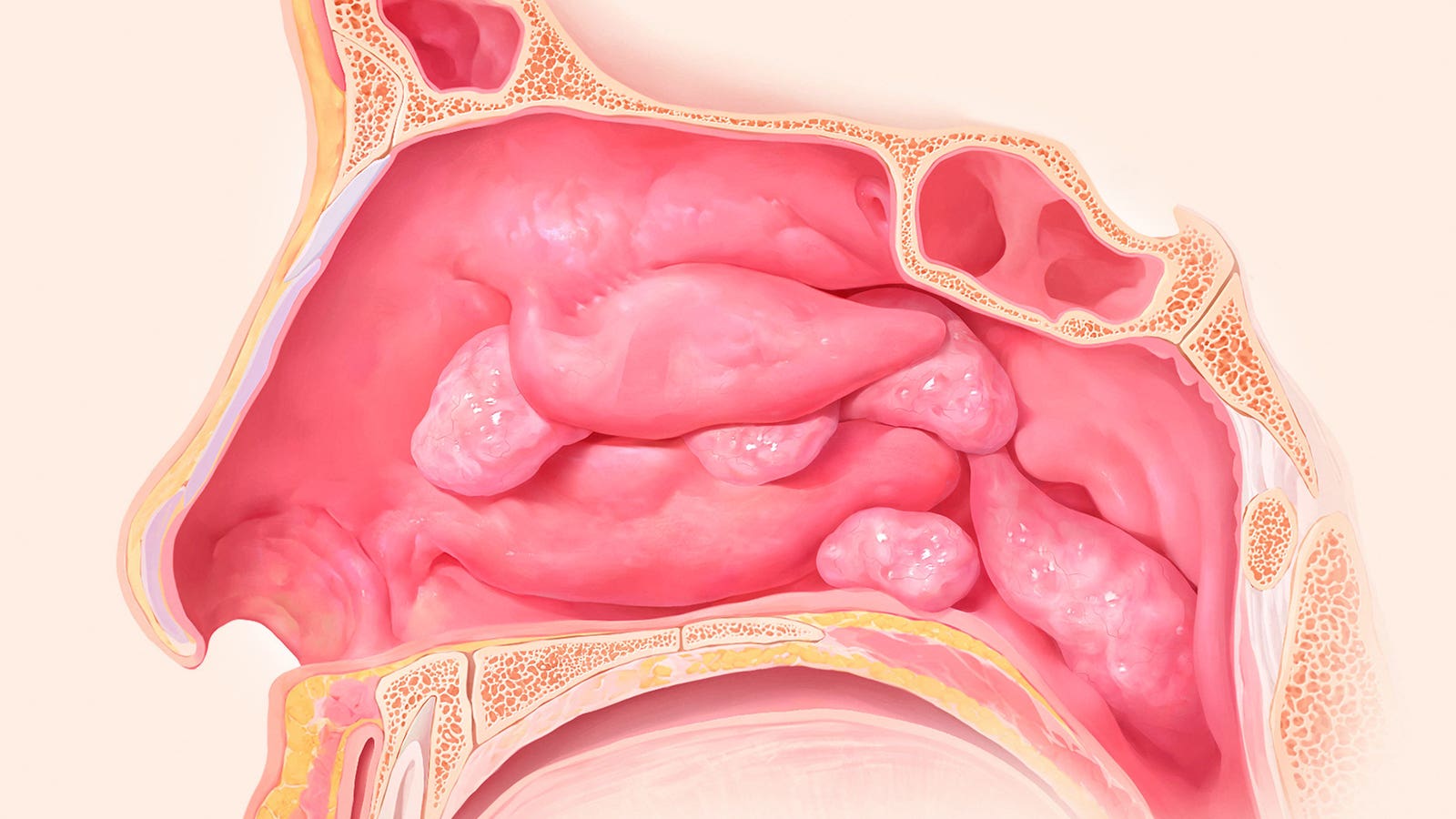Real-world study backs mepolizumab in rhinosinusitis with nasal polyps