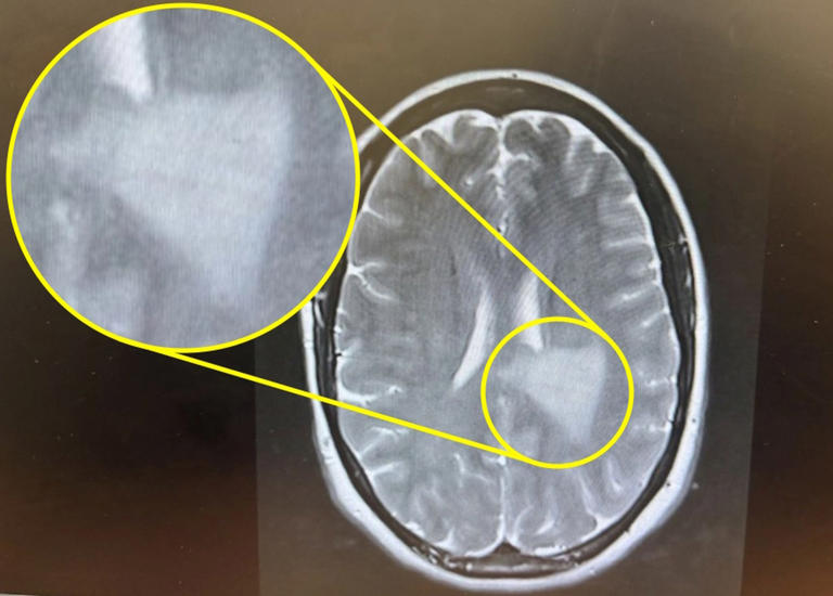 ‘My pins and needles were blamed on an old climbing injury – but it was ...
