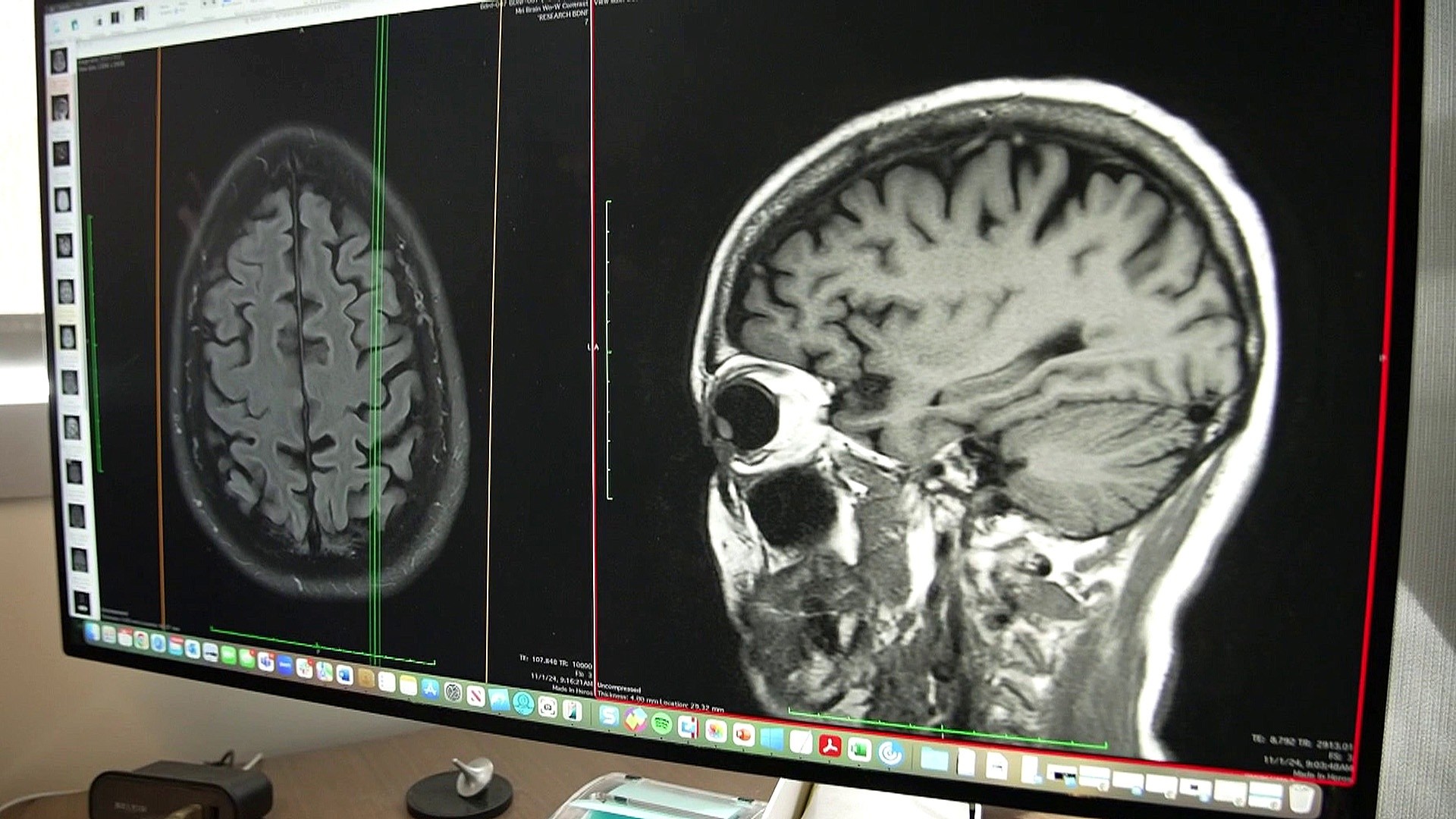 FDA approves new blood test to identify signs of Alzheimer’s