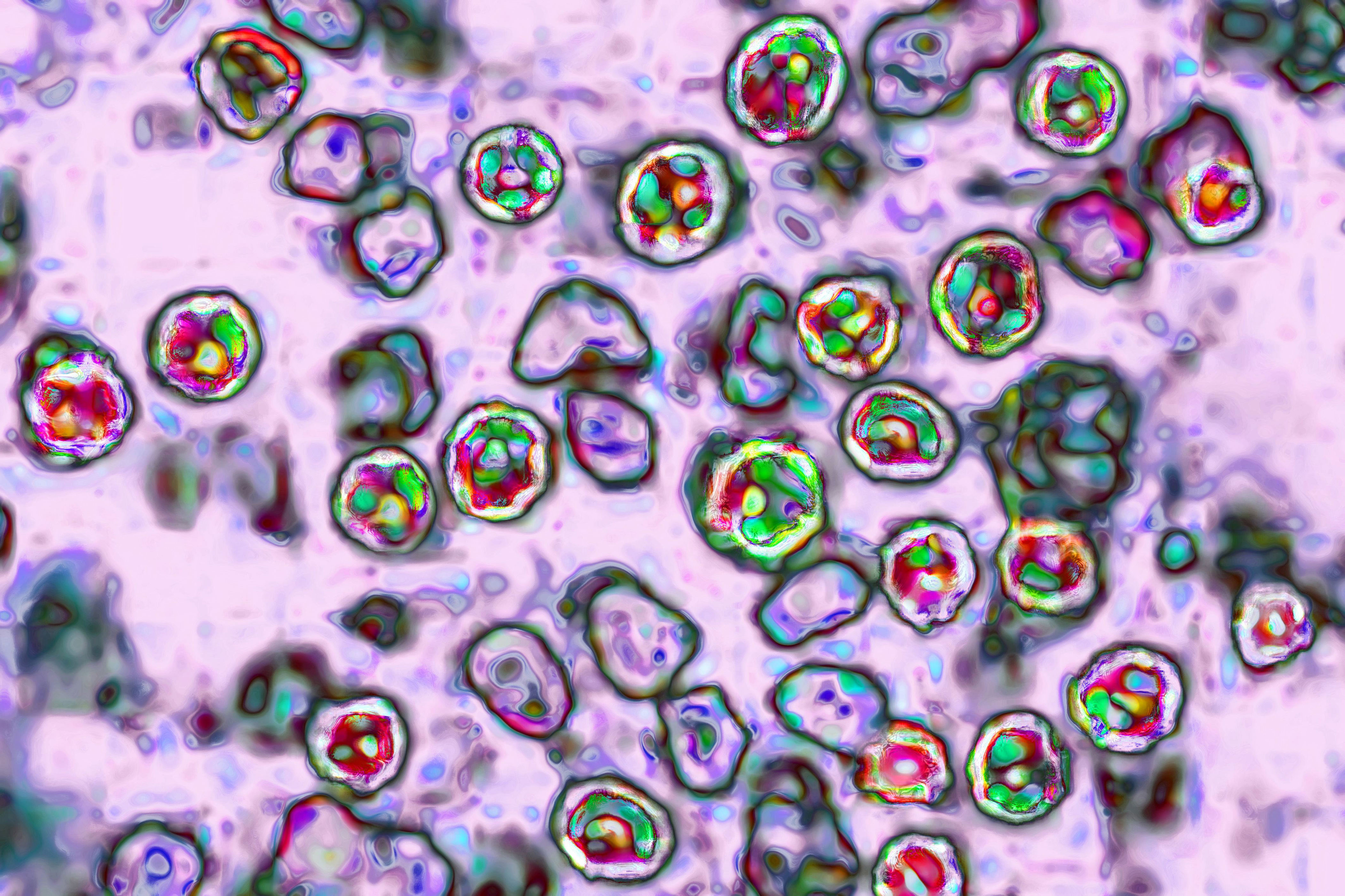 2 measles-related deaths reported in Pennsylvania, the state's first in 35 years