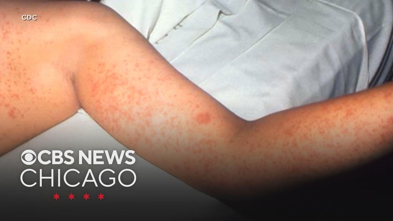 Kane County identifies two possible measles exposure sites after ...