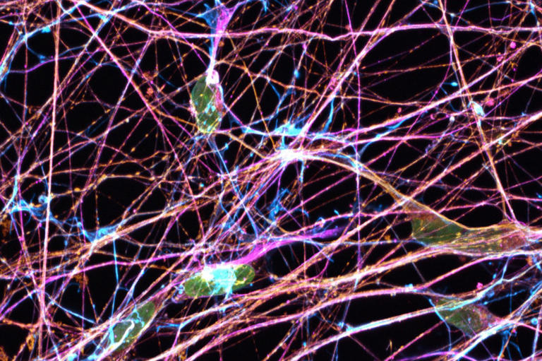 Nanopartículas que convierten astrocitos en neuronas muestran potencial en modelos animales