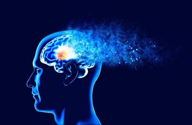 Stock image: Alzheimer’s disease in a 3D rendering.
