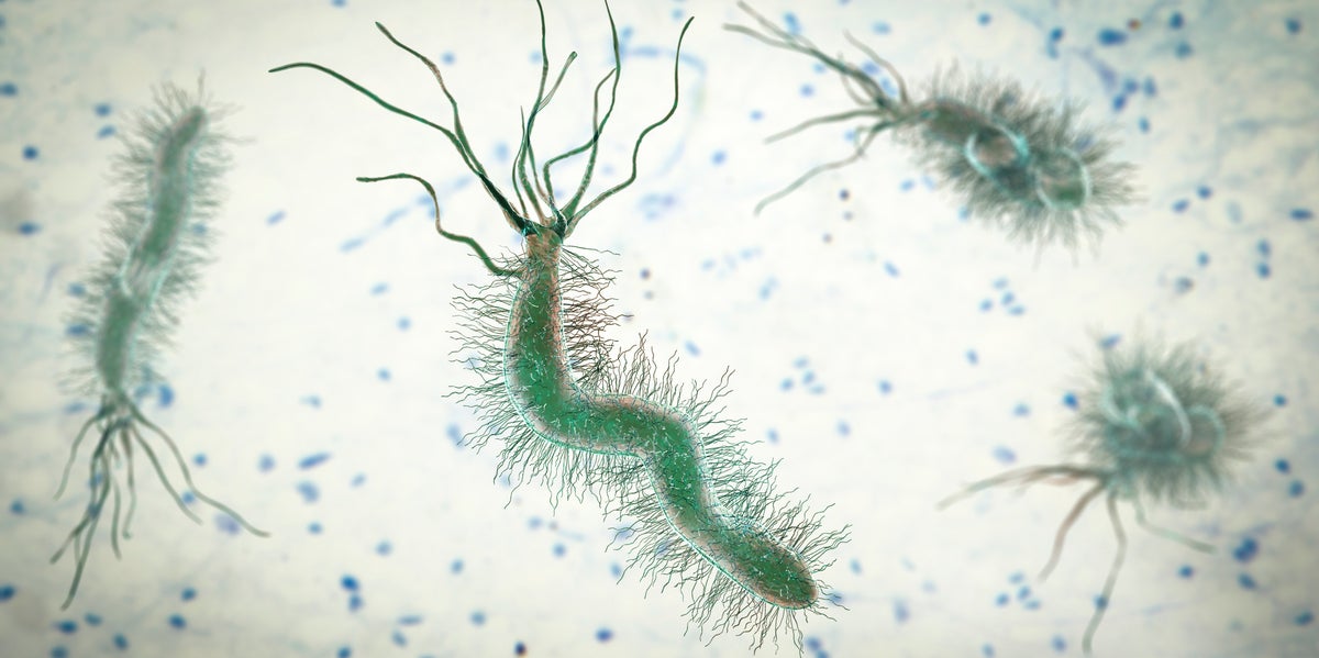 Common stomach bacteria linked to 1 in 5 bowel cancer cases in global analysis