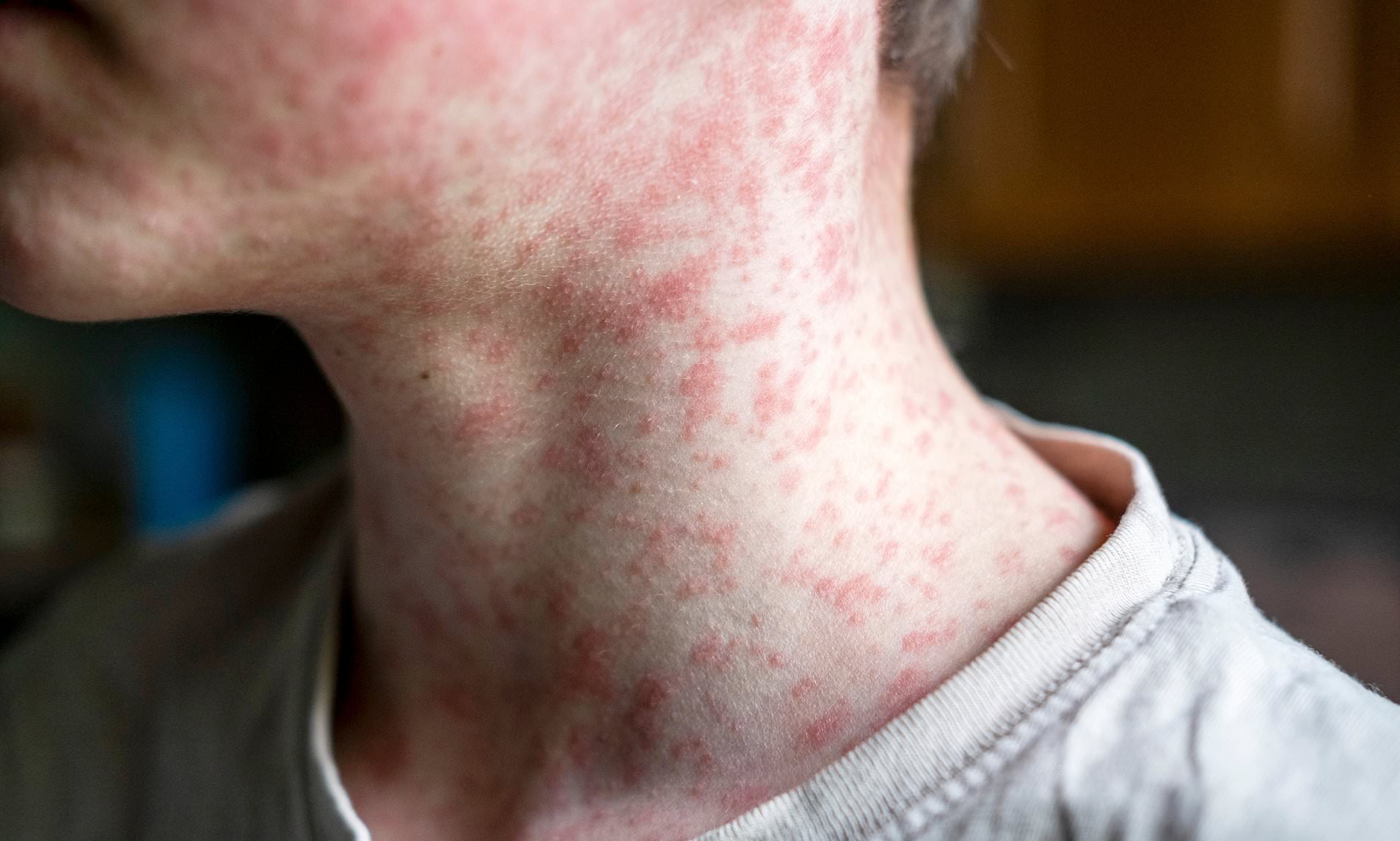 Two measles patients who died from virus identified amid growing controversy