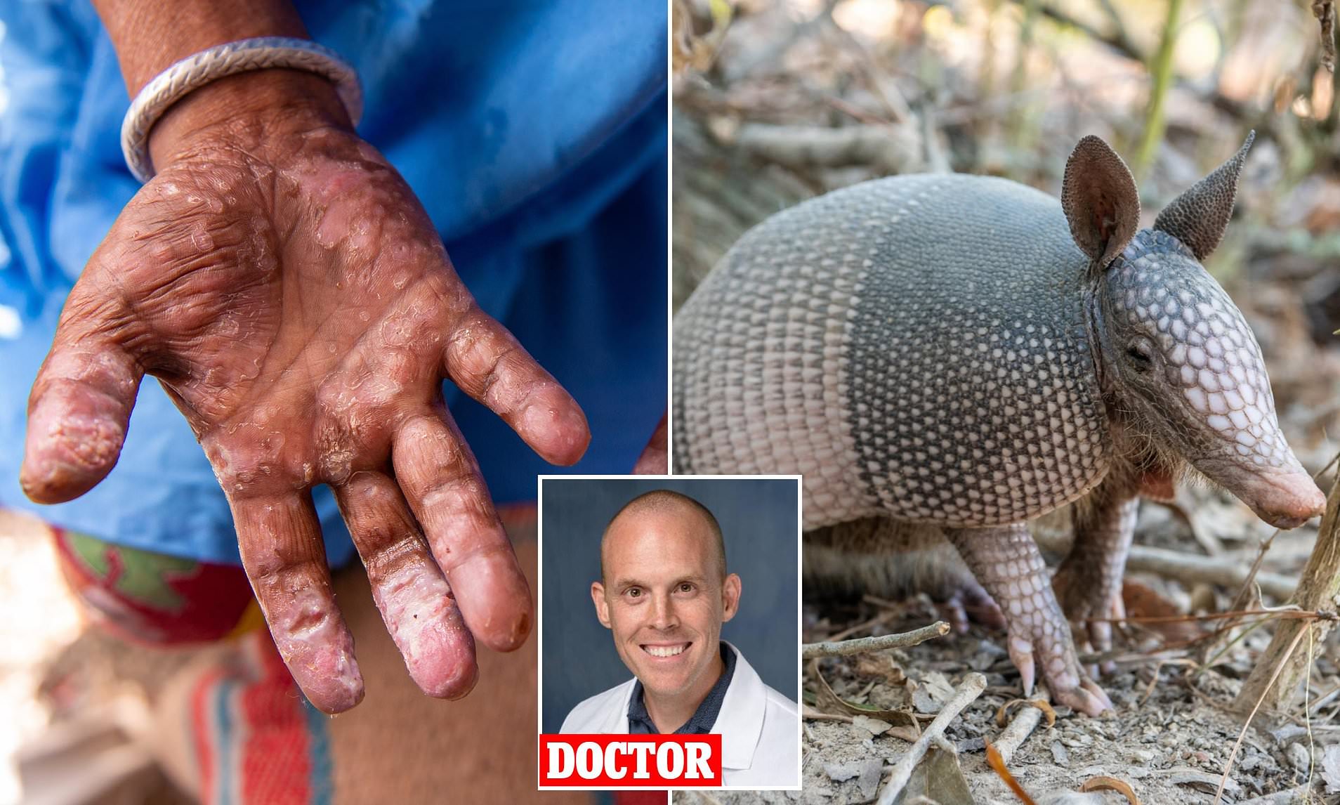 Ancient disease making a comeback... experts reveal surprising culprit ...
