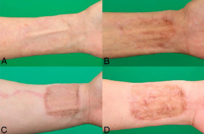 Skin graft from the inner arm, instead of the thigh, produces more ...