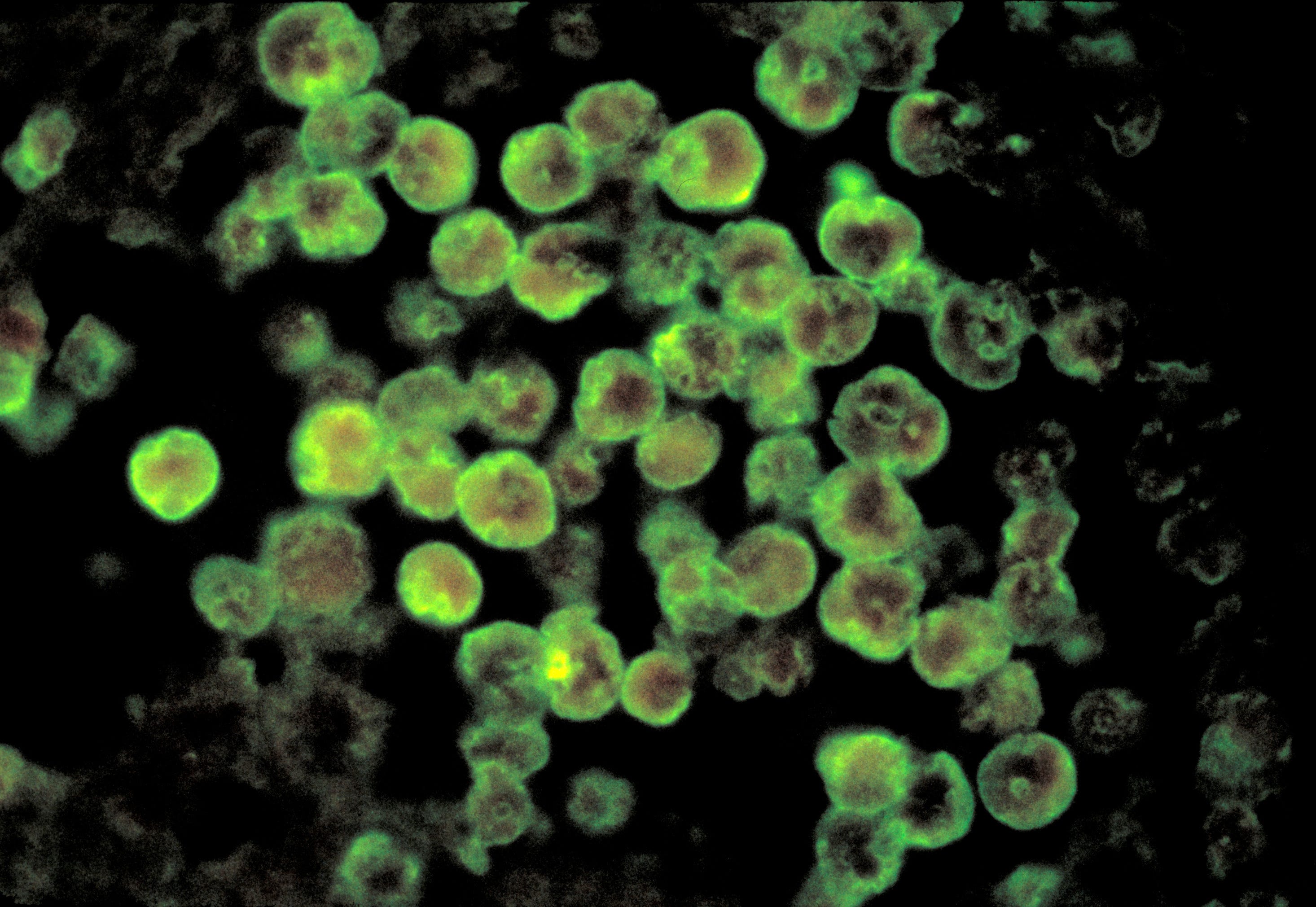 Teen's brain-eating amoeba infection likely linked to water feature