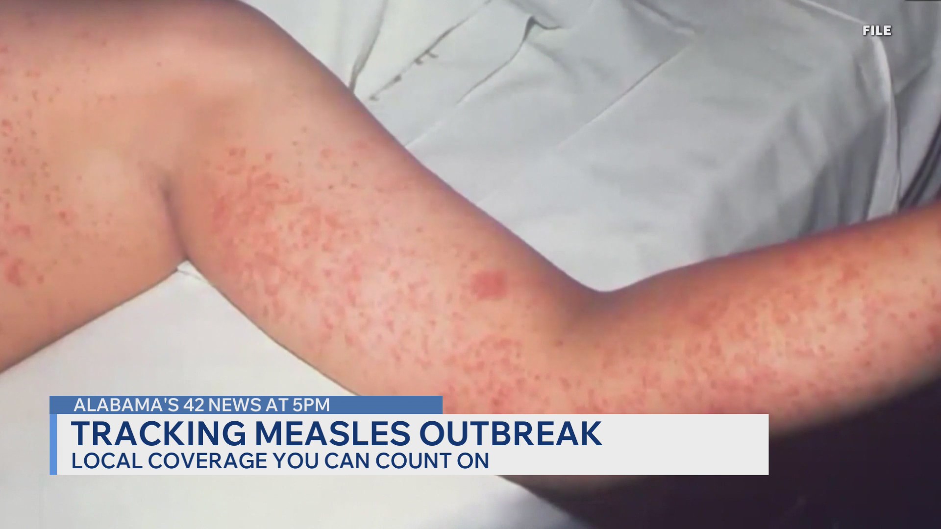 Tracking measles outbreak
