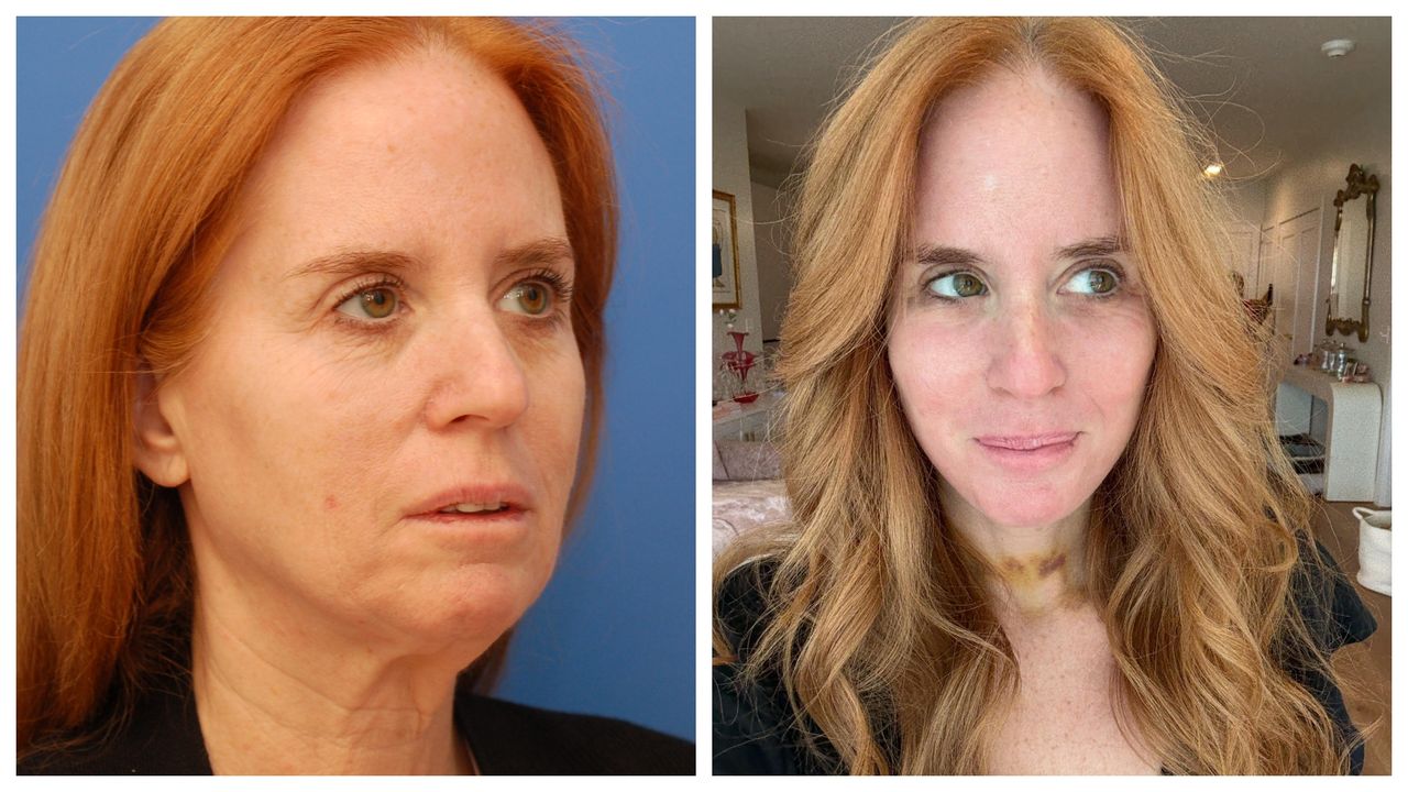 I spent my life savings on a facelift—it was the best investment I ever made