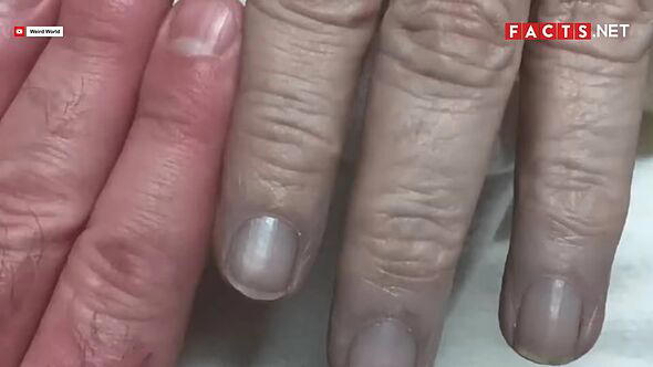 The condition prevents blood from carrying oxygen