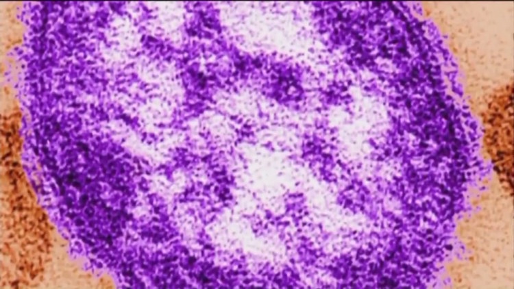 2 additional measles cases linked to ongoing outbreak at metro Atlanta ...