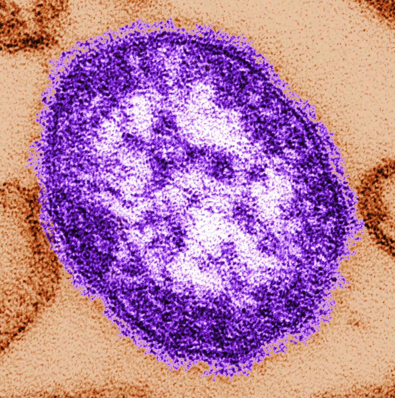 Pennsylvania woman dies of measles complications