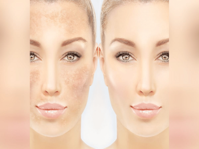 Bleach doesn't suit every skin type; keep these important points in ...