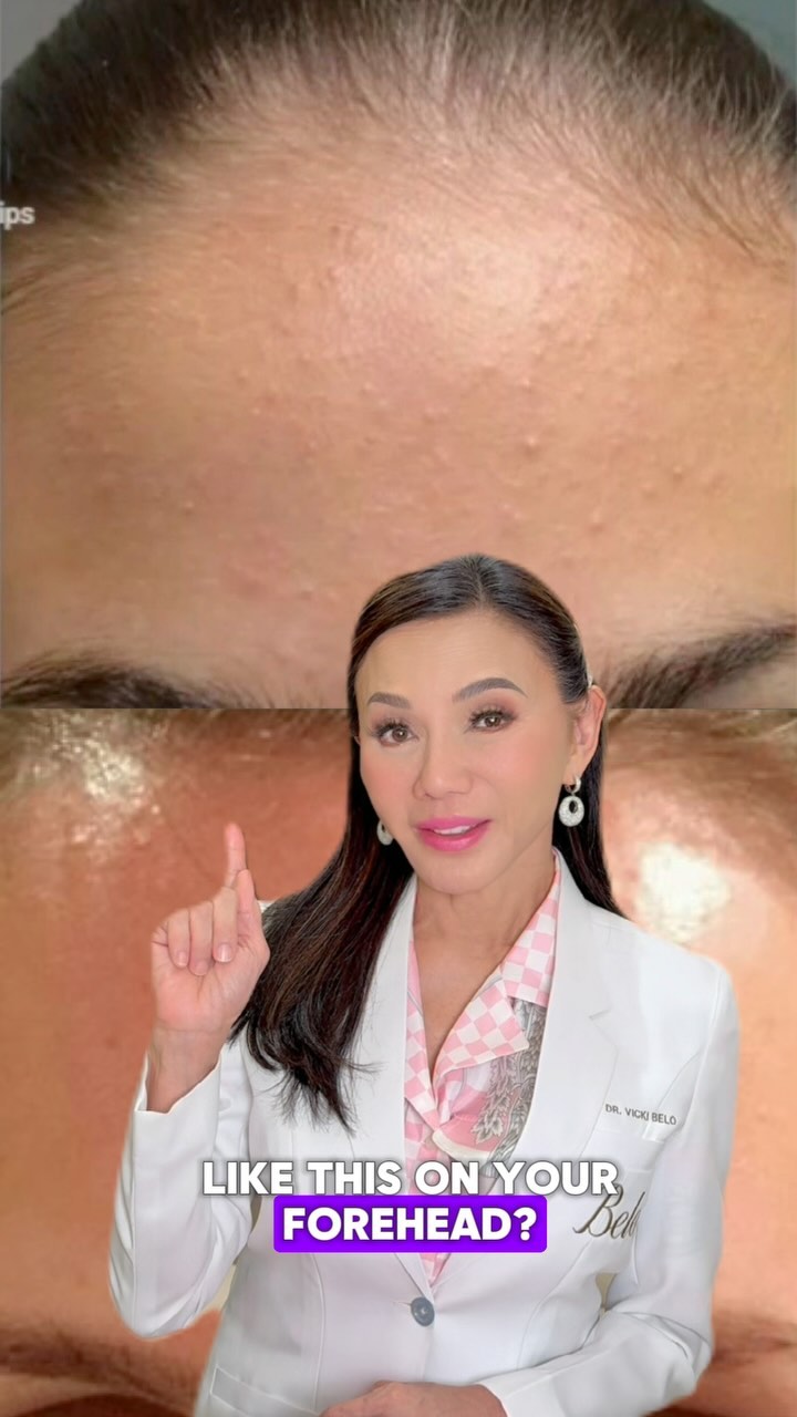 Dealing with a bumpy forehead or uneven skin texture?