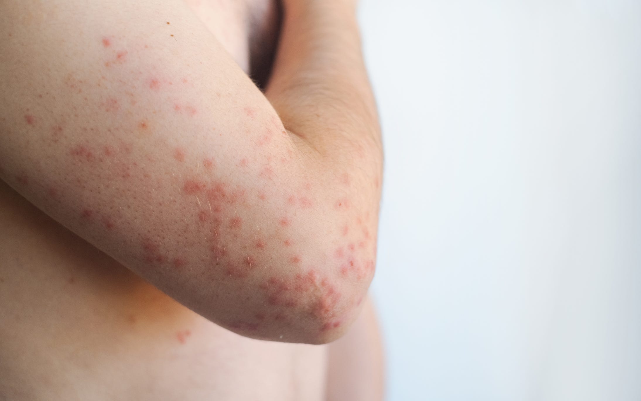 What to know, do about measles cases in PA, Delaware