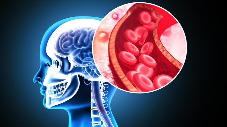 Strokes nearly double among adults under a certain age in disturbing trend